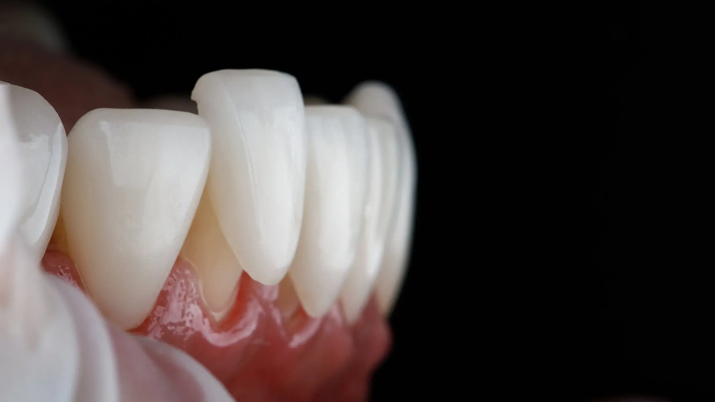 Carillas Dentales